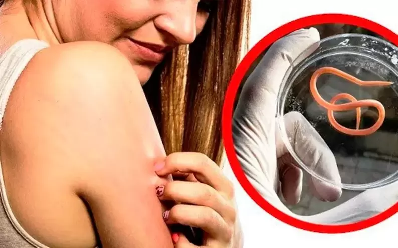 сверб і раздражненне пры паразітах у арганізме